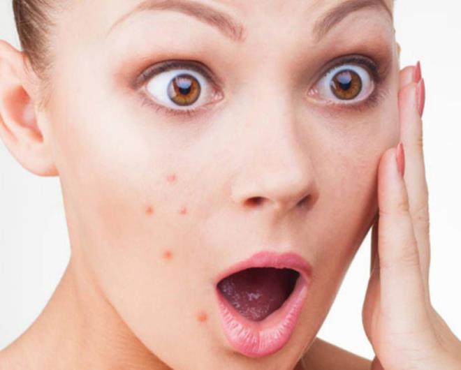 "Stresli bir dnem genelde renciler iin snav dnemleridir. Bu dnemde sivilceleriniz artabilir. Adet dneminde, hormon miktar deitiinden, sivilceler oalabilir. Ayrca var olan bir sivilceyi skmak, durumu daha da ktletirir. Hem cilde zarar verir hem de sivilcelerin artmasna neden olur. Gne , aknenin iyilemesini kolaylatrr. Ancak uzun sre gnete kalmak ciltte oluabilecek lekeleri arttrr...