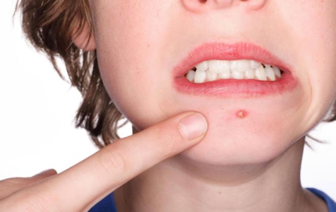 Karakoca, ayn zamanda "Akne zamannda tedavi edilmediinde iz brakarak iyileebilir. Tedaviye ge yant veren bir cilt hastal olduundan dzenli ve sabrl bir tedavi sreci gerektirir. Yaplan en temel yanl ise tedavide ge kalnmasdr. Sivilceler ilk grlmeye baladnda uygun tedavinin uygun zamanda verilmesi iin dermatoloji uzmanna bavurmak gerekir" uyarsnda bulunuyor.