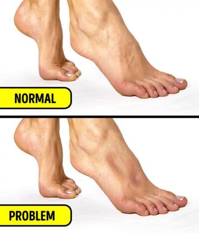 VCUTTAK TUZ VE SU ORANI    Vcudunuzdaki su ve tuz orann renmek iin ayak ba parmanzn stne basarak topuunuzu yukar kaldrn. 15 saniye boyunca bu pozisyonda ayakta durun. Eer ayan st ksmnda ukur oluursa bu durum vcudunuzda su orann, az tuz orann ise fazla olduunu gsterir.