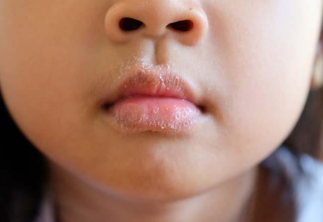 B2 VTAMN EKSKL ARETLER    <br>- Dudak atlakl,  grme bozukluklar, kiloda d, hareketlerde yorgunluk  ile kendini gsterir.