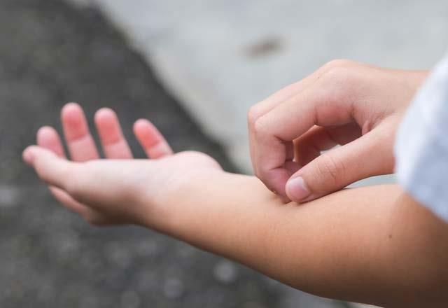 - Bunun dnda cilt zerinde dklme, kanma ve pullanma belirtileri de kendini gsterir.