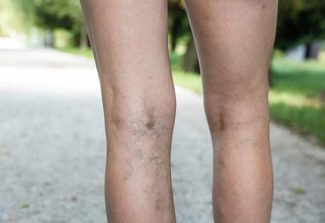 Olgunlam ide meyvesi, olduka dk kalorili olmas bakmndan diyetlerde yer alabilecek harika bir attrmalk. Ayrca diyet srasnda vcudun ihtiya duyduu pek ok nemli bileeni de ieriinde barndryor. Ancak, ok fazla ide tketmenin kabzla neden olduunu belirletelim.