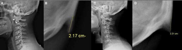 10 yldr gzlemleniyor  </b>  Bilim adam David Shaharr, 20 yldr klinik tedavi uzman olduunu belirterek &#8220;Ancak sadece son 10 yldr hastalarmn kafatasndaki bymeyi gzlemliyorum&#8221; aklamasn yapt.
