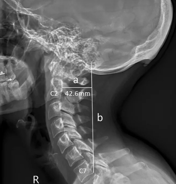 Her 4 genten birinde grlen bu durum, dijital ekranlar karsnda geirilen sreyle ilgili endielere bir yenisini daha ekliyor.