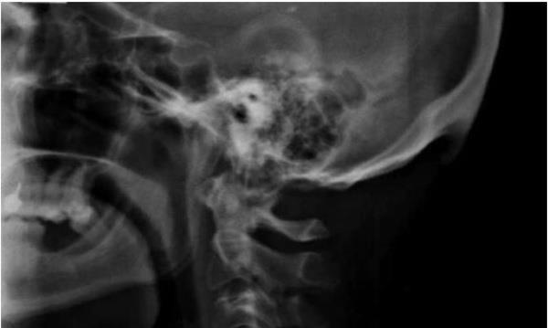 Ensenin stnde sivrilen 10-30 milimetre arasnda deien kntya, &#8216;d oksipital kabart&#8217; deniyor. D oksipital kabartya, tanabilir dijital cihazlar yaygnlamaya balamadan nce daha ok yal insanlarda rastland, genlerde ise olduka nadiren rastland belirtiliyor.
