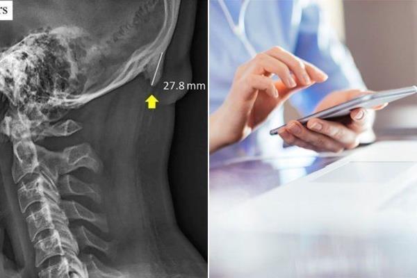 Avustralya&#8217;daki Sunshine Coast niversitesi&#8217;den bilim adamlar Dr. David Shahar ve Prof. Mark Sayers, 18-30 ya arasndaki 218 kiinin rntgen ekimlerini inceledi. Yaplan aratrmalar sonucu rntgen ekilen kiilerin neredeyse yarsnn kafatas eklinin youn cep telefonu ve tablet kullanmna bal olarak &#8216;deitii&#8217;, boynuzumsu bir kntya benzedii belirtildi.