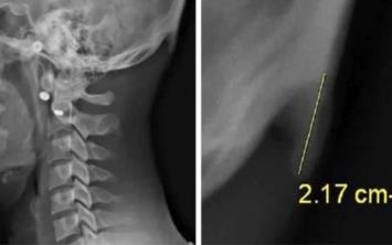 Avustralya&#8217;daki bilim adamalar Dr. David Shahar ve Prof. Mark Sayers yapt aratrma sonras youn telefon kullanmnn genlerin iskelet yaplarnda da deiikliklere yol atn ortaya kartt.