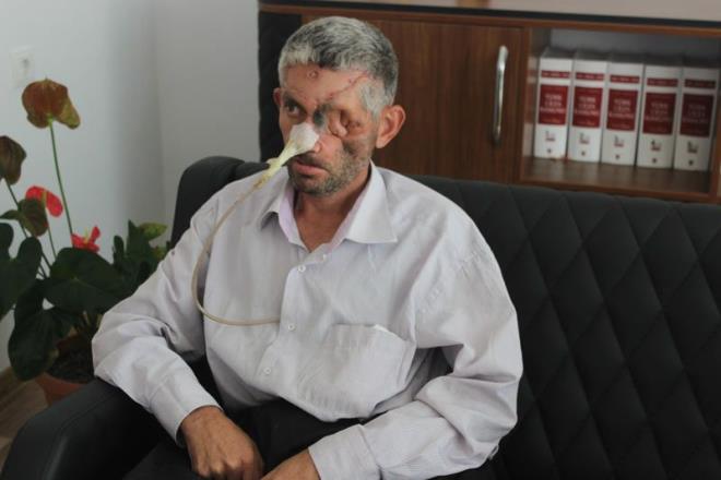 "hmal nedeniyle yarg srecini balattk&#8221;: Avukat Neslihan Graslan ise di hekiminin tetkik yapmadan, ila kullandrtmadan dii ekmesinin ihmalkarlk olduunu syleyerek, &#8220;Mvekkilim bir di ars sebebiyle az ve di sal merkezine gidiyor. Doktor mvekkilimin yznde ilik olduu halde herhangi bir tetkik veya bir ila kullanm tavsiye etmeden direk mvekkilimin diini o gn, gittii gn ekiyor. Bunun zerine mvekkilimin yzne btn iltihap yaylyor ve bundan sonrasnda da mvekkilim ameliyat olarak maalesef sol gzn ve yznn sol tarafn kaybediyor. Zaten mvekkilimin grntlerinde de grdnz zere maalesef byk bir maduriyet yaanyor. Mvekkilim de evli ve iki ocuk babas. Biz burada ihmal olduunu dnyoruz. Di hekiminin burada gerekli zen ve hassasiyeti gstermediini dnyoruz. Zaten bununla ilgili yarg srecini balattk, gerekli ikayetleri yaptk, durum u anda yargda&#8221; dedi.