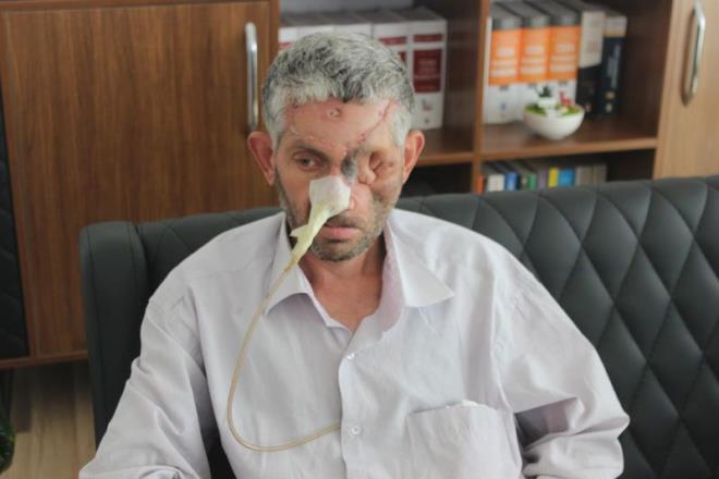 Diin ekilmesinin ardndan olunun yznde ilik olutuunu belirten Bulat, &#8220;Biz diten diye phelendik, kendisine sormadk, kendisi de bir ey sylemedi. Di ekildikten sonra ilik artt, ar da oald. Ameliyat ister dediler. Ondan sonra Hatay Mustafa Kemal niversitesi Aratrma ve Uygulama Hastanesine gnderdiler. Orada ameliyat oldu. Yz gz bu hale geldi, gznden de oldu yznden de oldu. Bizi ukurova niversitesi Tp Fakltesi Balcal Hastanesi'ne sevk ettiler orada da ameliyat oldu&#8221; dedi.