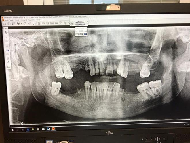 Para koparma iddias: Hastann ve ailesinin derdinin para koparmak olduunu ileri sren A.P. &#8220;Aileye bize de bilgi verin dedik. Aradan 15 gn geti bilgi alamaynca, ben kendi telefonumdan arayarak bilgi istedim. Ayrca ayet ekilen di sonucu bu olay yaansa bile biz o blgeden di ekmedik daha nce ekilmi zaten, rntgende de var bunlar. Bu olay iltihaplk di ekimiyle olan bir olay deil. Bunlarn amac ynlendirme ile hekimi tacizle para koparmak, biz bunu anladk. Biz teekkr beklerken bu tepkilere maruz kaldk&#8221; ifadelerini kulland.