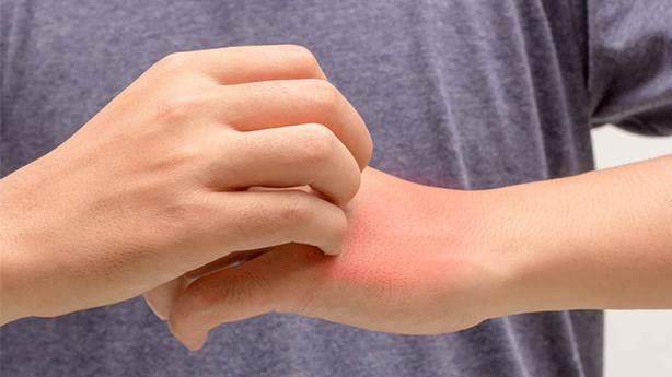 2- Sivrisinek srndan yrtanlar  <br>    Yaz aylarnn en sevimsizi misafiri sivrisinekler tarafndan srlmamak bence zc bir ey olmal. Sonuta kan ien bir canldan bahsediyoruz ve sizi tercih etmiyor.  Demek ki yeteri kadar tatl deilsiniz.