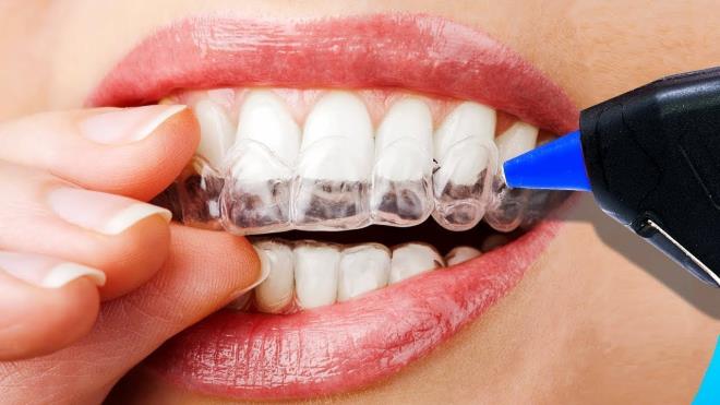 Medipol Mega niversite Hastanesi Pedodonti Uzman Dr. r. yesi Asl Patr Mnevverolu, 13 yana kadar tm bebek ve ocuklarn dzenli aralklarla dilerinin kontrol edilmesi gerektiine kar aileleri uyard. Dr. Patr Mnevverolu, yapt aklamada, ocuklarda di sal iin eker tketiminin ve gece attrmalklarnn en aza indirilmesi gerektiin bildirdi.    Dr. Asl Patr Mnevverolu; ocuklarn, yetikinlere oranla daha fazla az ve di sal problemi yaadna dikkati ekerek, u ifadeleri kulland: "Dnya Salk rgt ve Amerikan Pediatrik Di Hekimleri Birlii ilk di hekimi muayenesinin ilk di ktktan sonra yani 6 ay ile 1 ya arasnda yaplmasn neriyor. ocuklar daha fazla di sal problemi yaad iin dzenli kontrollerin yaplmas, gerekli nlemlerin alnmas olduka nemli. Bu nedenle ebeveynlerin ocuklarn sadece dileri ile alakal sorun yaadklarnda deil dzenli aralklarla di hekimine kontrole gtrmeleri, koruyucu nlemleri almalar, rkler ok fazla ilerlemeden dolgularn yaptrmalar ocuklarn hayat kalitesini artrr".