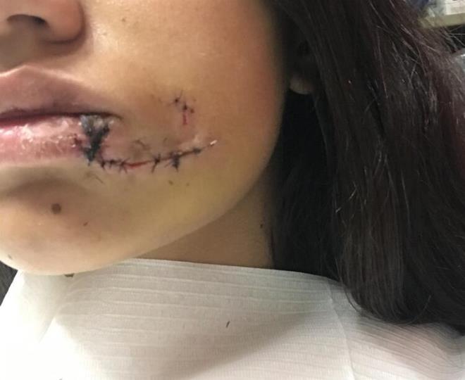 Kpek, kz yznden srd. Hastaneye kaldrlan kzn yzne 40 diki atld.