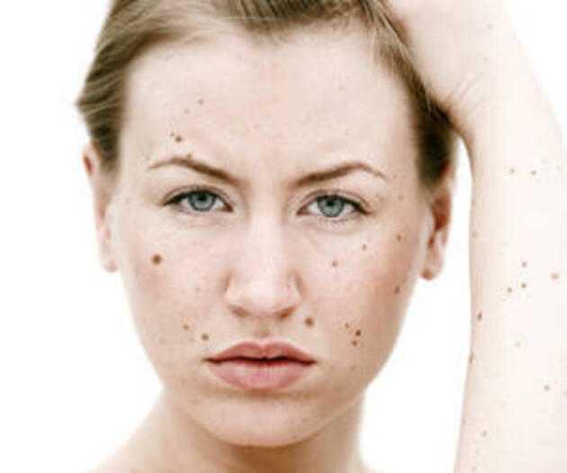 KANSER RSK TAIYAN BENLERN ZELLKLER UNLARDIR:  Olaand grnmler olabilmektedir. Akl koyulu alanlar, hafif pembemsi alanlar grlebilmektedir. Kenarlar simetrik deil, girintili kntldr. Baz yerleri daha ak, baz yerleri daha koyudur.