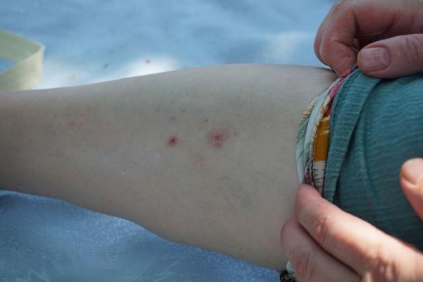 "SVRSNEKLER FESLEEN VE BBERYE KOKUSUNA GELMYOR": <br>Sivrisineklerden korunmak isteyen vatandalara tavsiyelerde bulunan Do. Dr. Kutlubay, "Fesleen, biberiye gibi bitkiler eer ortamda varsa onlarn kokusuna sivrisinekler pek gelmezler. Kimyasal ya da bitkisel sinek kovucular var. Limon, lavanta, okalipts, karanfil, tarn ya sinek kovucu zellii bilinen yalar. Sivrisinekler daha ok parlak giysilere gelirler. Yalanmas fazla olan kiileri srrlar. '0' kan grubunda olan kiiler farkl bir salg retiyor, bu salgy alglayarak bu kan grubundakilere geliyor. 'A' kan grubunda olanlar ise daha az srr. Isrdktan sona en gzel uygulama souk su, ya da buz tutmaktr. Limonu kesip, limon srebilirler. Karbonat ya da aspirini eritip o karm o blgeye srebilirler. Alerjik bir durumu varsa ve reaksiyon gelitiyse mutlaka en yakn salk kuruluuna bavurmak gerekir" ifadelerini kulland.