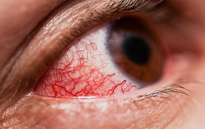 Krmz gzler: Konjunktivit olarak da adlandrlan krmz gzler, koronavirse yakalanm hastalarda grlen bir dier sorun.