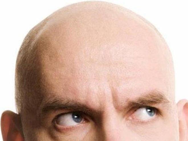 Sa kayb: Doktorlar, ar geen koronavirs hastalnn ardndan sa dklmesiyle karlatklarn aktaryor. Ar stresli durumlarda vcudun 'nemsiz ilevleri durdurmas' nedeniyle salar dklyor. Hastalk sonras dzenli demir almyla salarn yeniden kaca aktarld.