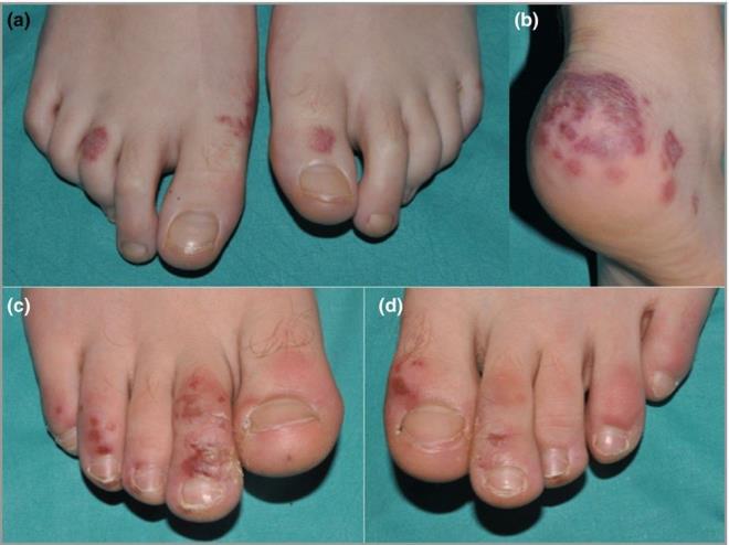 Kovid parmaklar: Koronavirs parmaklarda geni apl deri tahrilerine yol ayor. Sklkla ayak parmaklarnda ve topuklar da grlse de el blgesinde de ayn sorunla karlamak mmkn. Kovid parmaklar yzey alan olarak maklopapler kabarklklardan daha byk.