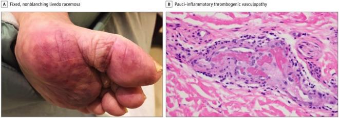 Damarlarda mavilik: Livedo retiklaris ya da damarlarn maviye dnmesi, yeni tip koronavirs (Kovid-19) hastalarnda grlen cilt problemlerinden. Cilt morarm bir grntye de sahip oluyor ve ileri yal insanlarda hastaln sert geeceine iaret ediyor.