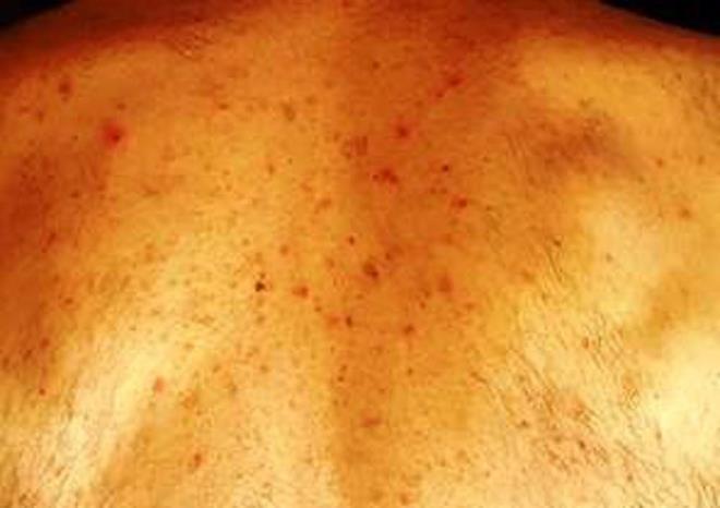 Kabarcklar: Su kabarc ya da keseli kabarklklar, yine tm vcudu etkileyen koronavirs rahatszlklarndan. Bulgulara gre; su kabarcklar, ounlukla elde olmak zere hastaln ilk zamanlarnda grlyor. Orta iddette geecek hastalklara iaret ettii ifade ediliyor.