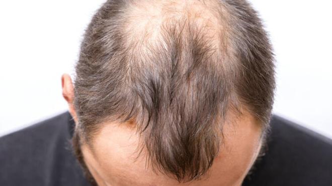 1. SA DKLMES  <br>Yakn zamanda koronavirs yenen bin 500 kiinin katld bir aratrmada, her drt kiiden birinin, sa dklmesi yaadn ortaya karld. Sz konusu durum, kafa derisinde olduu gibi, ka ve kirpik gibi vcudn dier ksmlarnda da grlebiliyor.