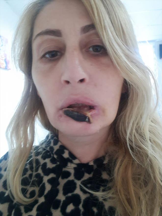 Akdeniz niversitesi Hastanesinde dudana iki kez doku nakli yapldn anlatan Uzunolu, ameliyatlarn yeni tip koronavirs (Kovid-19) nedeniyle ertelendiini bildirdi.