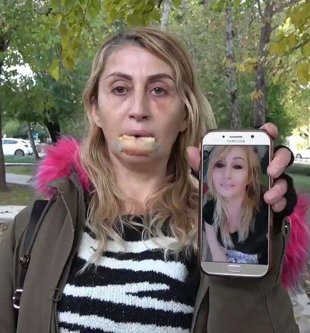 Uzunolu'nun Akdeniz niversitesi Hastanesinde tedavisine balanm, doku nakli gerekletirilmiti.