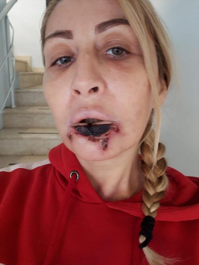 Dolgudan sonra dudandaki ana damarn tkanmas sonucu dokularn tamamen ilevini yitirdiini anlatan Uzunolu, dudan kaybettiini, ok aclar ektiini ifade etti.