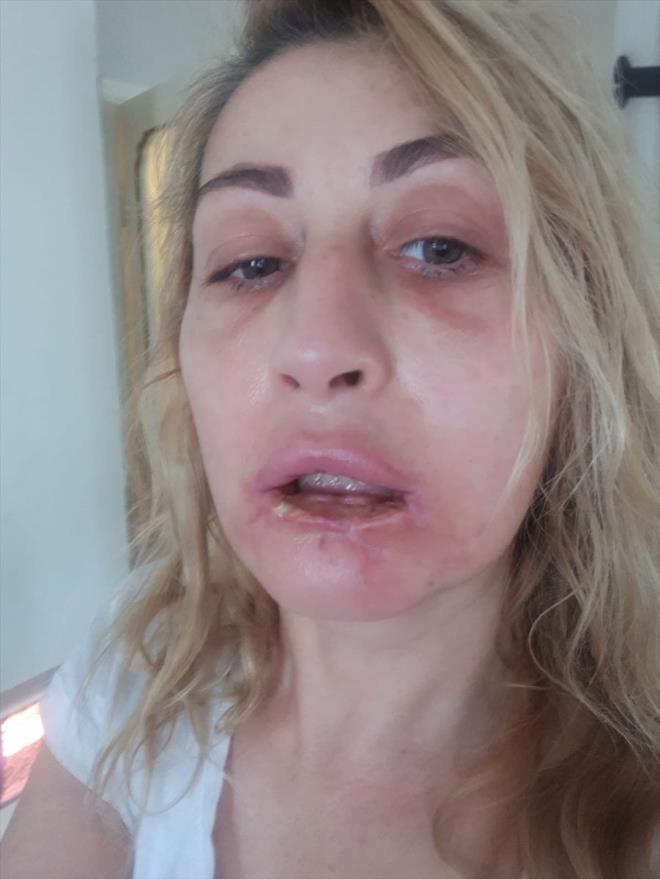 Uzunolu, "Psikolojimdeki ac kaybn karl yok. Yanl uygulanan estetiklerin sonucu vahim olabiliyor, lmle sonulanabiliyor. Ben glmesini unuttum, mimiklerimi kaybettim. Kahve imeyi, scak yemek yemeyi zledim. Dudanz yoksa siz tam olamyorsunuz." ifadelerini kulland.