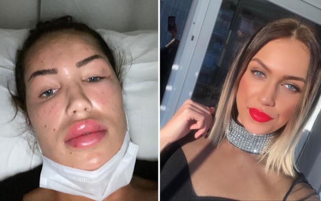 Konak ilesindeki bir gzellik merkezi ile sosyal medya hesabndan iletiim kuran Seline Ferah alkan, &#8216;genlik as &#8216;ad altnda yzn nemlendirmek iin yaplan uygulama sonucu hastanelik oldu. Yznde ok sayda yara oluan gen kadn, tedavisinin ardndan savcla su duyurusunda bulundu.