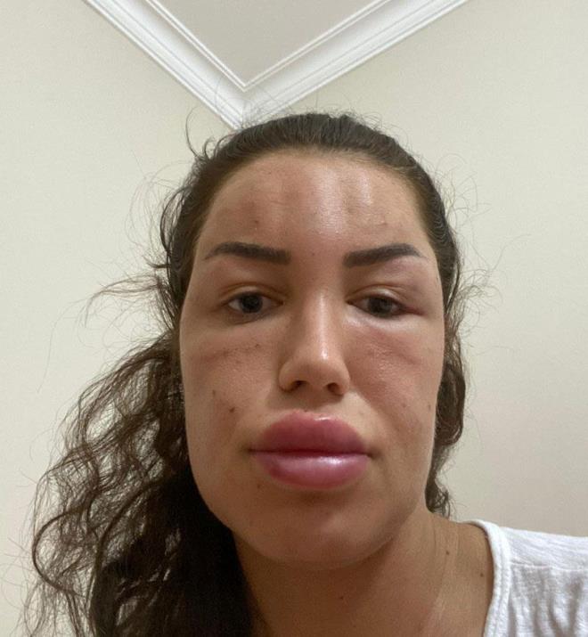 Gen Kadnn Avukat Bahar Yldrm ise yle konutu:    <br>&#8220;Hukuki sre ile aratrmalar balayacaktr. Kadn haklarnn korunmas iin gzellik uruna daha fazla kadnn madur edilmesini istemiyoruz. Seline Hanm'n bana gelen bu talihsiz olayn tekrar yaanmasn istemiyoruz. Amacmz Seline Hanm'n maduriyetinin bir nebze de olsa giderilmesi, hafifletilmesidir. Tabii ki bu srecin takipisi olacaz sonuna kadar, ayn zamanda toplum bilincinin de artmasn istiyoruz. Mvekkilime genlik as denilerek bu ilem yaplm. Uygulamann ad her ne kadar genlik as olsa da yani bunu genletirmek iin deil, mvekkilim cildini tazelemek iin yaptrm, kar taraf bu ekilde bir neride bulunmu. Cildinin nemlenmesini istiyor. Kar tarafn bununla ilgili bilgisi var, bu ilemi mvekkilime nermiler. Burada ama genlemek deildir. Zaten 24 yandadr mvekkilim inallah elde edeceimiz sonu rnek olur, toplumuza iyi bir netice elde etmeyi bekliyoruz. Kar tarafn bir kusuru varsa cezalandrlmasn istiyoruz. Kim hakl kim haksz dava srecinde belli olacaktr. Yarg srecinin sonulanmasn bekleyeceiz."