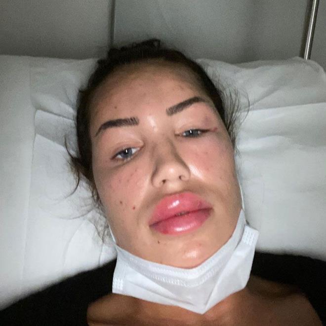 Gittii gzellik merkezini nceden bilmediini belirten alkan, &#8220;Sadece sosyal medya hesaplarndan grtm. Sonrasnda gidip, bilgi aldm. Ardndan bir arkadama dantm o da tavsiye de bulundu. Bunun zerine iyi olacan dnerek yzm iin &#8216;genlik as&#8217; ad altnda bir uygulama yaptrdm ama sonu iyi olmad. nk her kadn gzel olmak ister, her kadn gzel olmay da hak ediyor. Ben 24 yandaym, genlemek iin deil, bu uygulamay yzm nemlendirmesi iin yaptrdm ancak bama byle bir ey geldi&#8221; diye konutu.