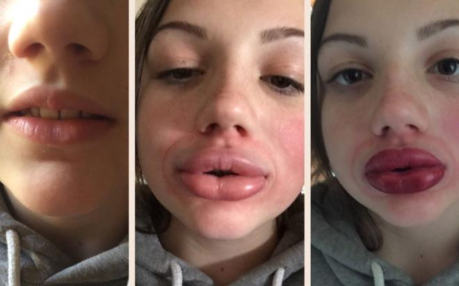 Klinik deneylerde ortaya kan yan etkiler, dolgu yaplan blgede iltihaplanma ve ilik olarak gzlemlendi.