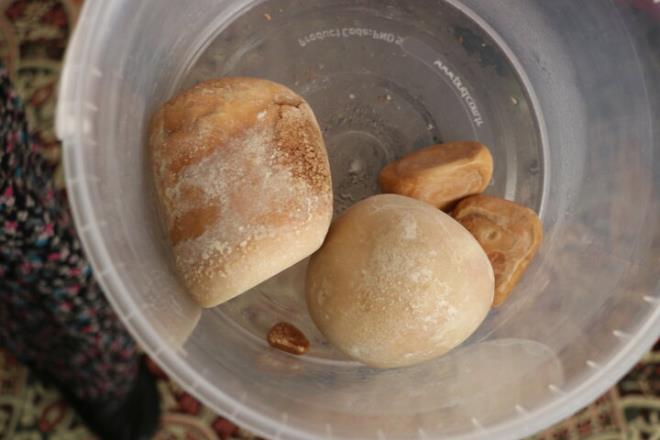 Hastann 16 yl nce mesane kanseri nedeniyle ameliyat edildiini, barsaktan yapay mesane yapldn ifade eden Zmrtba, unlar kaydetti: Barsaktan yaplan yeni mesaneler zaman zaman genileyip olduka byk boyutlara ulaabiliyor. Hastamzda da barsak salglarnn etkisiyle yapay mesanedeki talar ok bym ve mesanenin eklini alm. Talar karmakta olduka zorlandk fakat baarl bir operasyon oldu. Hastamz tamamen iyiletikten sonra yapay idrar tutma cihaz takarak idrar karmasna zm salamaya alacaz.