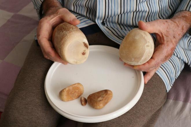 Zmrtba ve ekibi tarafndan ameliyat edilen Kul, mesanesindeki yaklak 2 kilogram arlnda olan 5 tatan kurtuldu. Kul, doktorlara teekkr ederek, Salma kavutuum iin mutluyum. Ultrasonda byk olduunu sylemilerdi. Ama bu kadar byk olduunu tahmin etmiyordum. ifadelerini kulland.