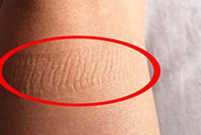 Bacak, ayak ya da ayak bileklerinizde sebepsiz ilikler ortaya kabilir. Kalbin iyi ekilde pompalanmamas halinde kan damarlarndaki svnn dokulara szmas ile birlikte ortaya kan ilik durumunda, kiinin doktora grnmesi yaplacak en faydal ilem olacaktr. zellikle ayanzda orap giydiinizde, lastik ok fazla rahatsz ediyor ve beraberinde yara izleri oluuyorsa mutlaka doktora grnmek gerekmektedir.