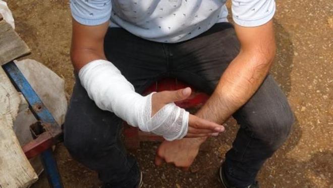 Gler?le anlatktan yaklak 45 dakika sonra sa kolunda arlar balayan Kahraman, Yksek htisas Eitim ve Aratrma Hastanesi?ne gitti.    Burada doktorlar Kahraman?n kolunun atladn tespit ederek, sargya ald.