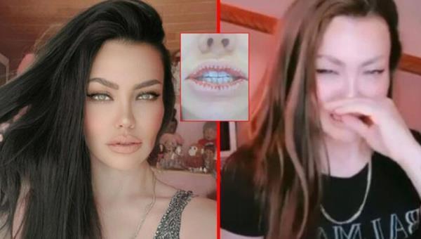 Pek ok nl dudaklarnn daha dolgun gzkmesi iin aba harcarken, Lara aksine dudaklarn klttrmt.