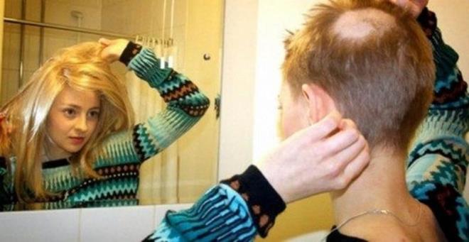 7. Trikotilomani: Sa ekme taknts <br>Trikotilomani rahatszl olan kiiler, kendilerine salarn ekerek zarar vermek iin kar konulamaz bir istek duyuyor.Bu kiiler salar haricinde vcutlarnda kalar, kirpikleri, sakallar gibi vcutlarndaki dier kllar da ekme istei duyuyor. Bu taknt ounlukla vcutta kolay fark edilebilir kelliklere yol ayor.