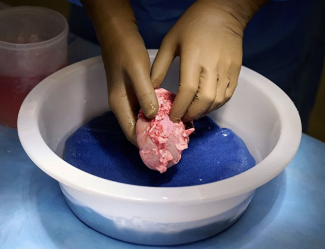 OLDUK�A NORMAL B�R �EK�LDE �ALI�MAYA BA�LADI    Nakil i�leminin ard�ndan b�bre�in hastayla uyumu �� g�n boyunca g�zlemlendi. Ara�t�rmay� y�neten organ nakli cerrah� Dr. Robert Montgomery, nakledilen b�bre�in i�levinin test sonu�lar�n�n "olduk�a normal g�r�nd���n�" s�yledi.