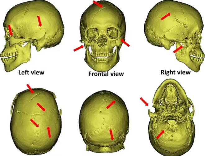 13 BIAK YARASIYLA LDRLD    skeletin zerinde 13 tane  'V? eklinde iaret bulundu. En derinin ise kafatasnda olduu grld. Adamn kalbini veya akcierleri gibi hayati organlar delen bak yaralar nedeniyle ld tespit edildi.     te yandan bilim insanlar, aftn katiller tarafndan kazldna ve daha sonra adamn cesedini ieri brakp yola devam etmeden nce delii doldurduklarna inandklarn syledi.