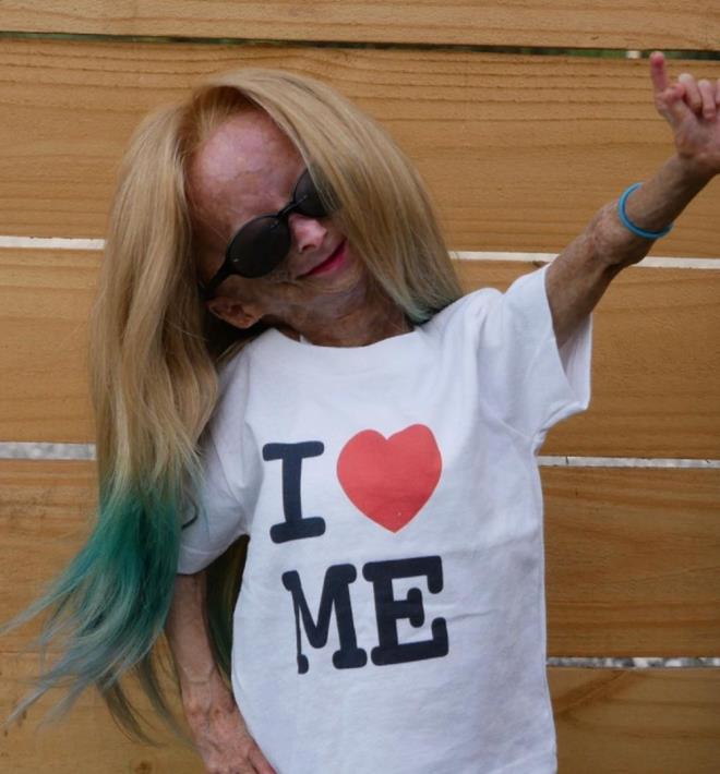 Pallante kznn, yatlar tarafndan yaplan  ayrmclnn yan sra ccelik, vcut ya eksiklii ve kas ve eklem sertlii gibi eitli salk sorunlarndan muzdarip olduunu belirterek, ?Adalia bir aylkken doktorlar onun bymesinden memnun deildi. Pallante, nce ortaya kan semptomlardan biriydi? aklamasn yapt.