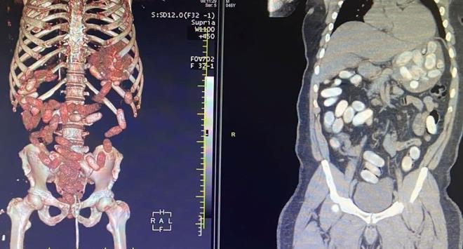 TOPLAM 8 K TUTUKLANDI    Operasyonlarda toplamda 11 kilo 180 gram kokain ele geirildi ve 1'i organizatr, 7'si kurye olmak zere 8 kii gzaltna alnd. pheliler, sevk edildii adliyede karld hakimlike tutuklanarak, cezaevine gnderildi.
