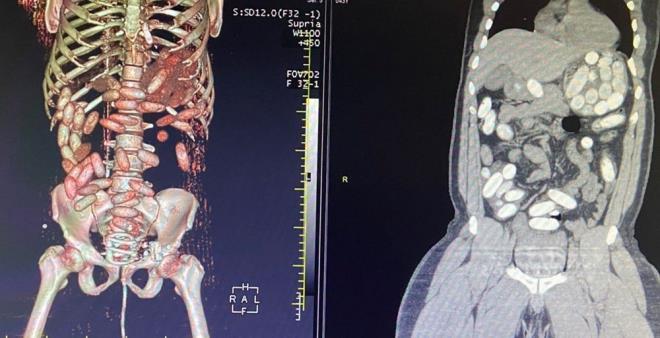 Yolcuda, 'yutucu' tespit cihaz ve ardndan salk kuruluunda yaplan muayene sonucu 48 adet kapsl ve toplam arl 760 gram kokain ele geirildi.