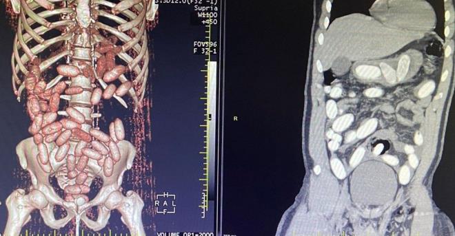 Yaplan n kontrollerde phelilerin midelerinde normal d baz materyaller olduu belirlendi. Gmrk Muhafaza ekiplerince savclk talimat dorultusunda detayl bilgisayar tomografi ekilmesi iin salk kuruluuna gtrlen 6 yolcunun yaplan tarama ve muayenelerinde 761 adet ve toplam arl 10 kilo 420 gram kokain tespit edildi.