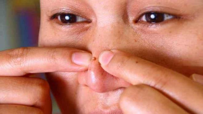 PEK SVLCE PATLARMAK ZARARLARI NELERDR?  <br>  Ciltteki gzenekler tkandnda ii ya (sebum) veya irin ile dolmu kk kntlar meydana gelir. Biz bu ilie ksaca ?sivilce? diyoruz. Sivilceler birka gn iinde daha byk bir hale gelir ve sonunda kendiliinden patlar. Bu, vcudun sivilcelere kar verdii doal bir iyileme mekanizmasdr. Bu doal sre sivilcenin iddetine bal olarak 2 ila 7 gn srebilir. Bir baka ifadeyle, sivilceleriniz 2 ila 7 gn arasnda kendiliinden geer.