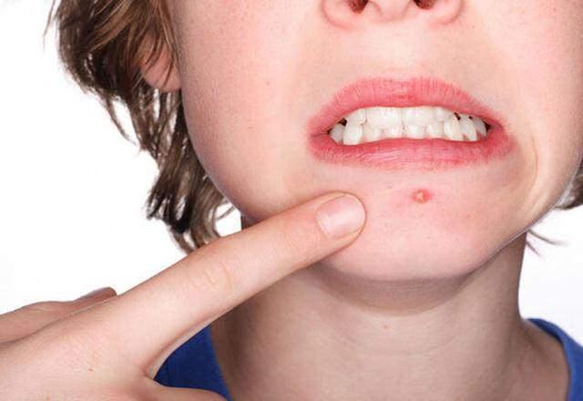 Yaplan tetkikler sonrasnda ise Tang?n intracranial (beyin) bir enfeksiyon yaad ortaya kt. Yani Tang?n birden fazla beyin apsesi vard ve beyninin iinde bir iltihap olumutu. Yaad talihsiz durumu anlatan Tang, ?Yzmde sivilce kt ve kolayca sktm. Bir sivilcenin bu sonulara yol aacan asla tahmin edemezdim? dedi.