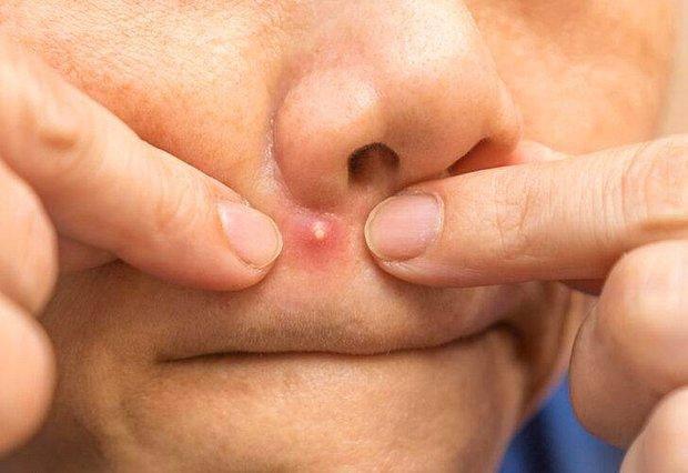 Cilt iinde irin, iltihap veya ya bulunun kk keseciklere pstl denir.