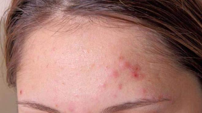 Dermise yaylan zararl svlar, sivilcenin daha da ktlemesine, kzarkla ve arya neden olur. Ek olarak, cildinizde tedavisi zor ukurlar ve izler brakabilir. Bu nedenle, sivilcelerle oynamak, patlatmak veya skmak yerine kendi doal srecinde gemesini beklemek en mantklsdr.