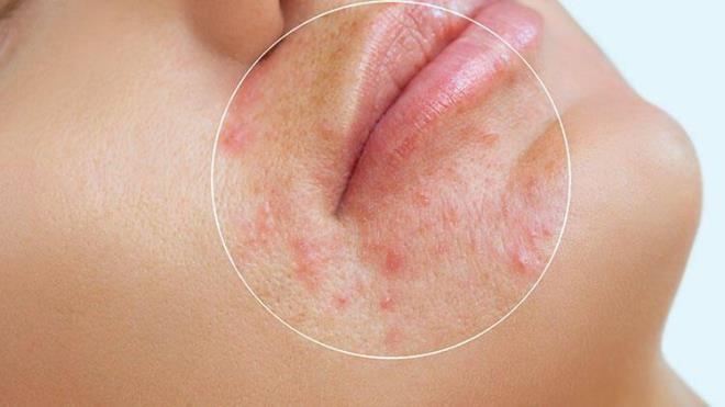 N'DE SIKINTI YAANDI  <br>  Korkutan bir haber de getiimiz aylarda in?den gelmiti. Tang isimli inli adam dudaklar ile burnu arasnda kan sivilceyi patlatnca lmle burun buruna geldi.